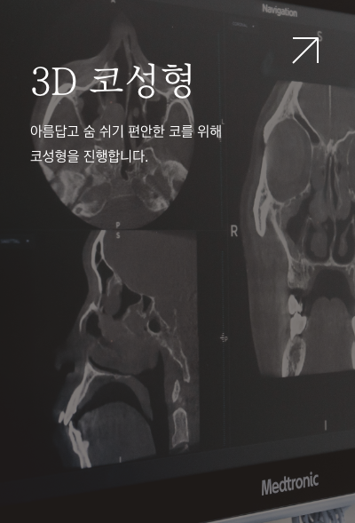 3D 코성형. 아름답고 숨 쉬기 편안한 코를 위해 코성형을 진행합니다.