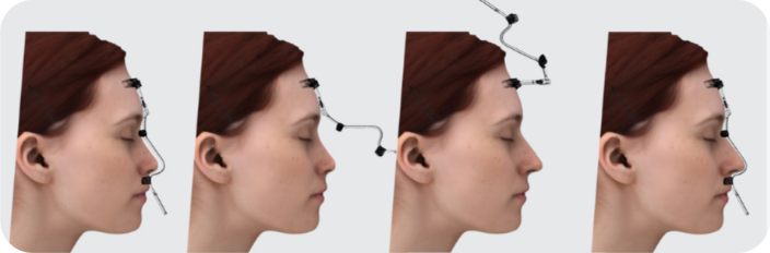 명작 이비인후과 3D 프린팅 코성형가이드